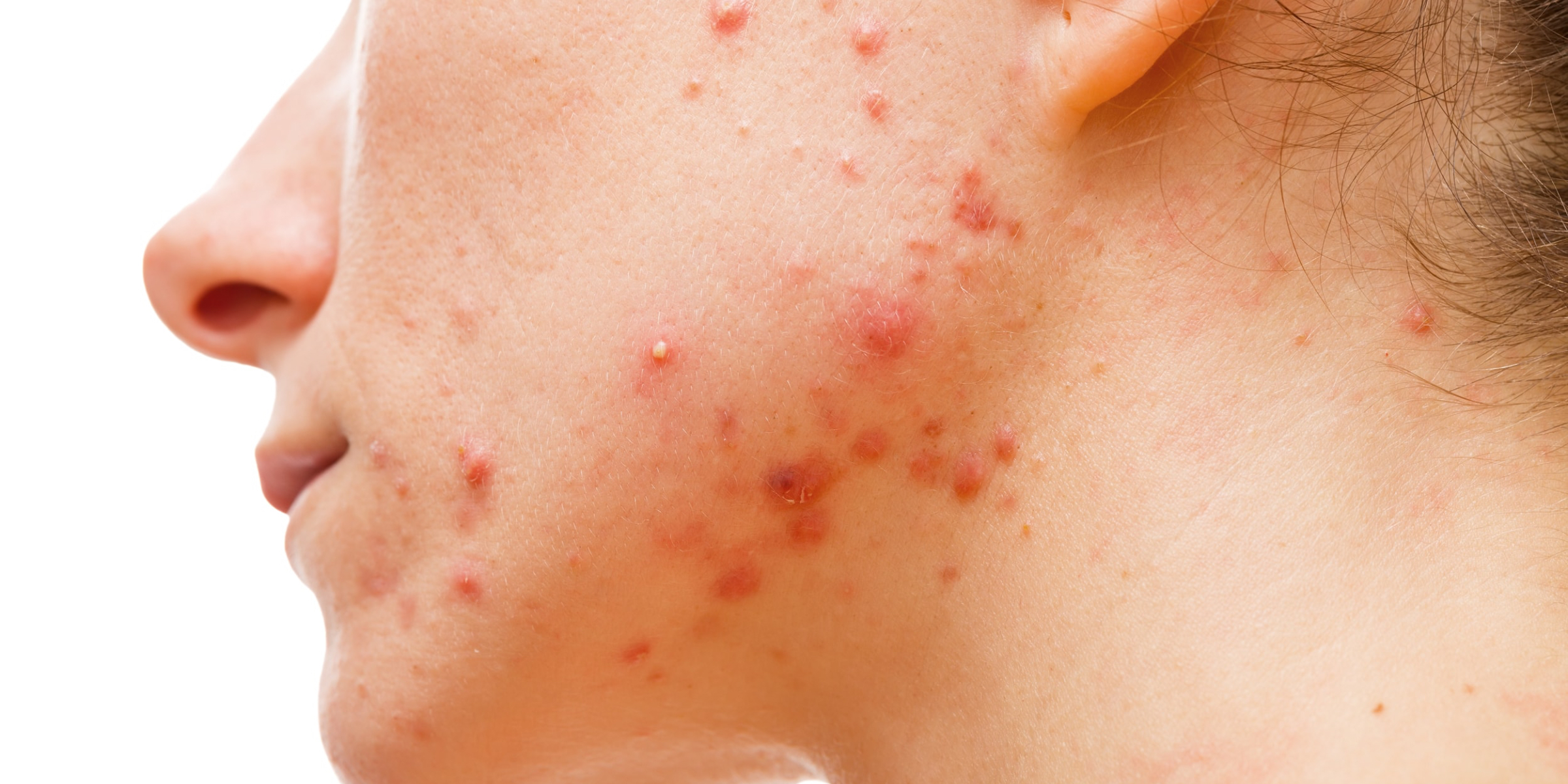 Close-up on acne and acne scarring