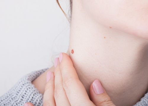 Woman with a mole on her neck