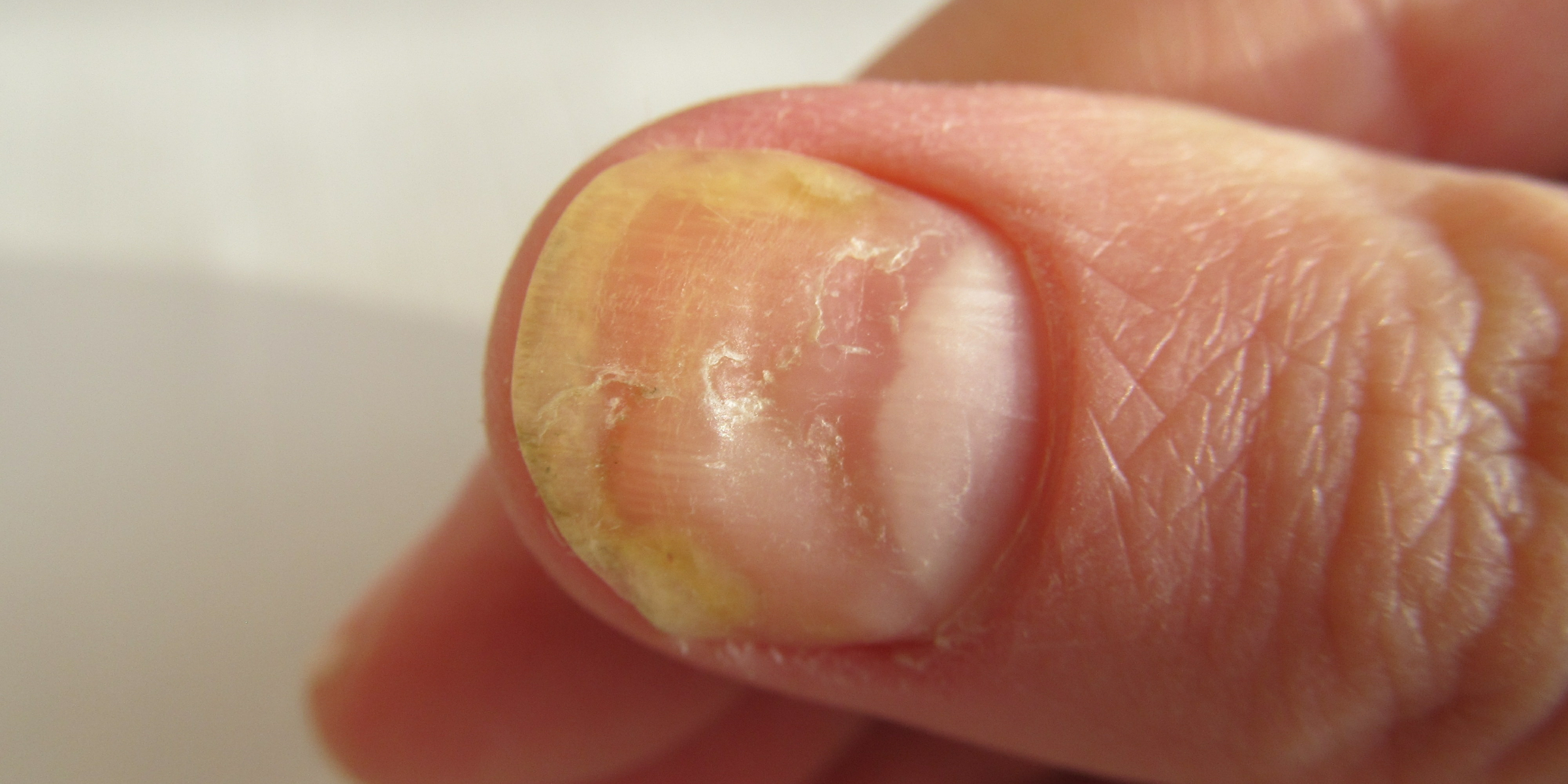 a nail disorder in the thumb