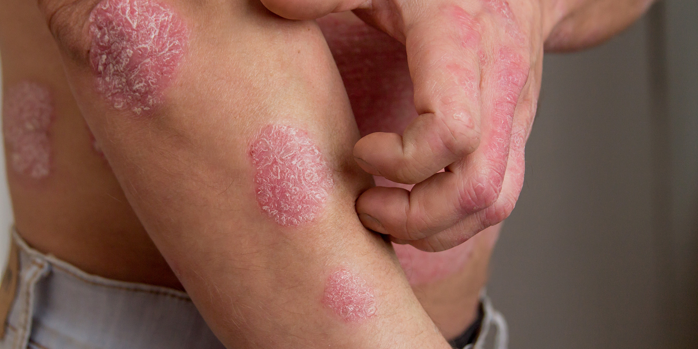 Psoriasis on the arms