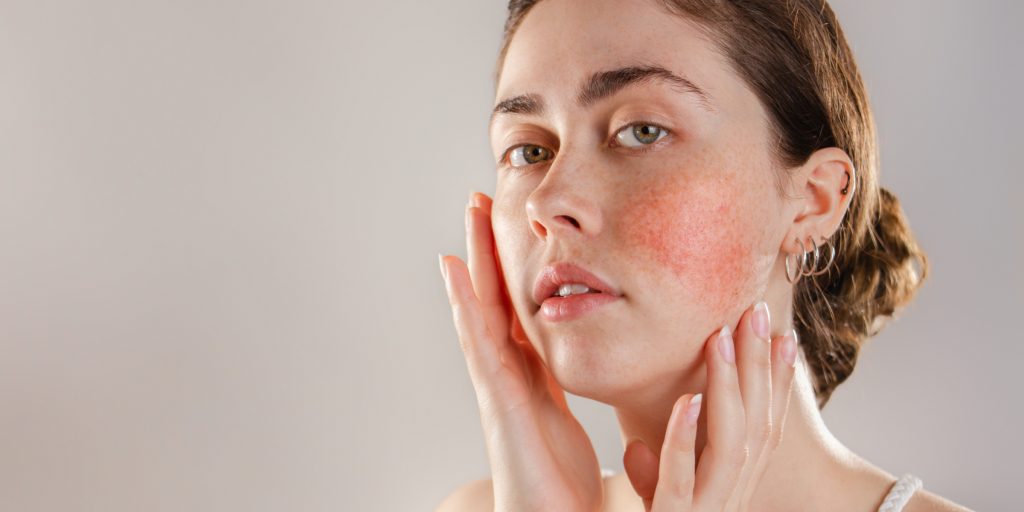 melanotan rosacea Awareness Month - JDDonline Rosacea | Altru Health System