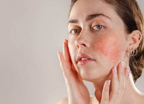 Rosacea on a woman's cheeks