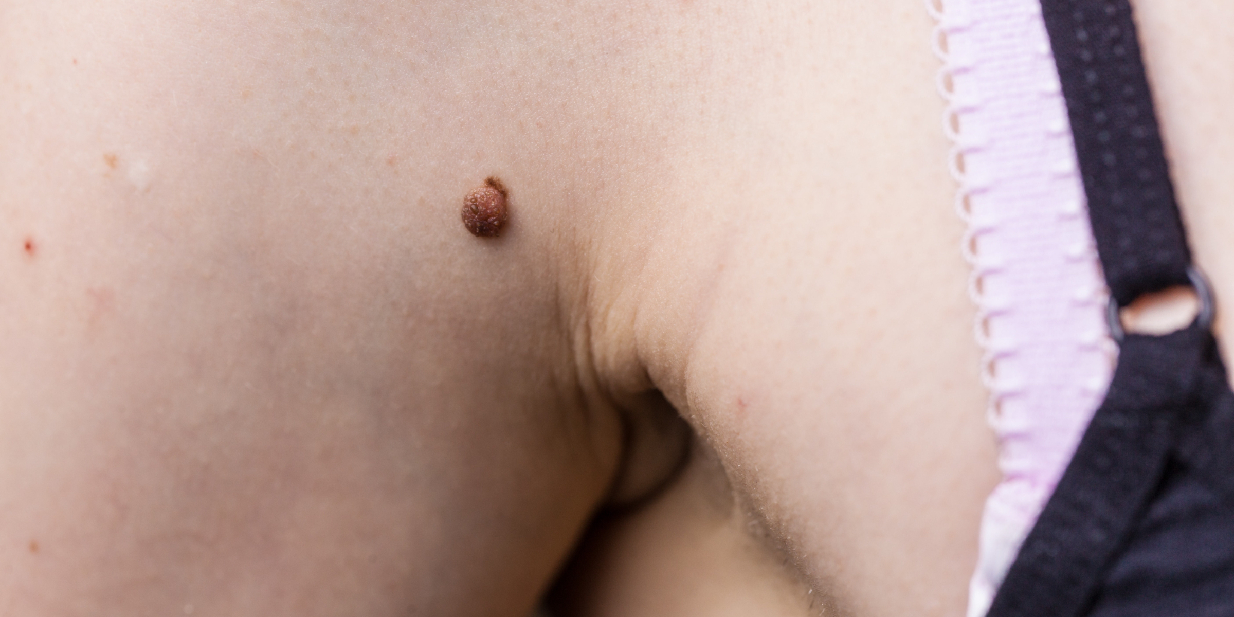 Skin tag on a woman's arm