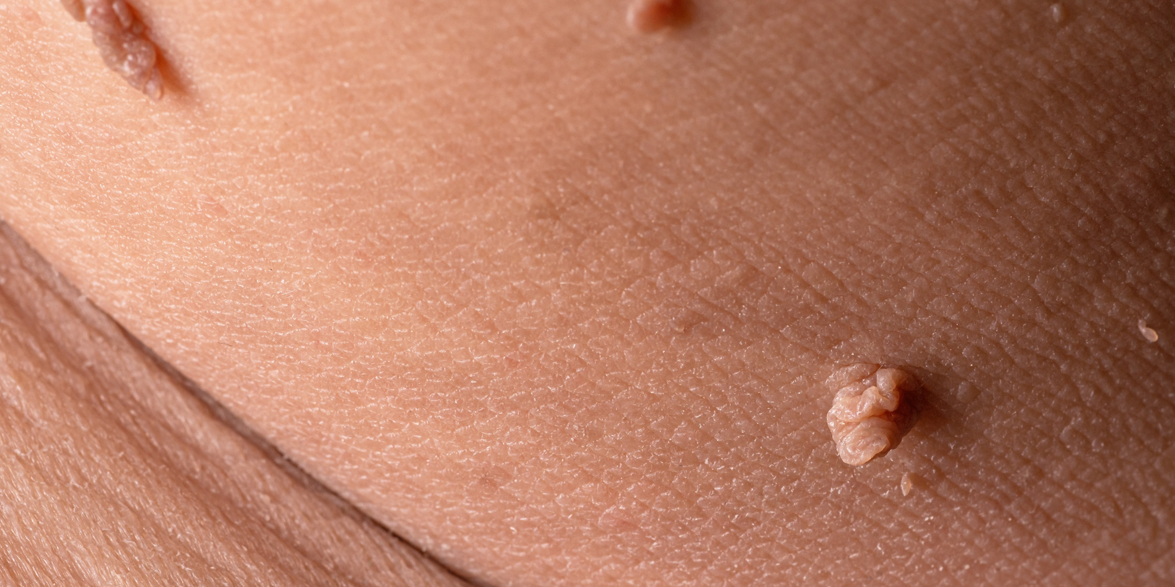 skin tags on the body