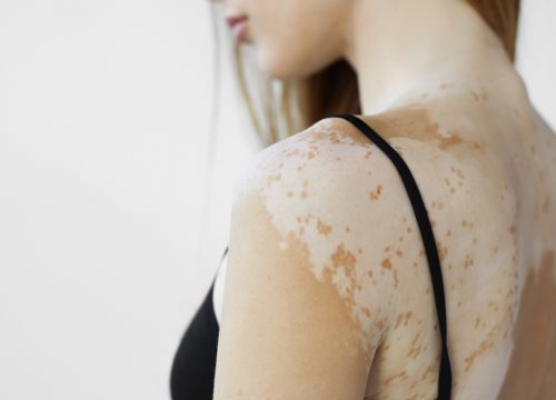 vitiligo on woman's back