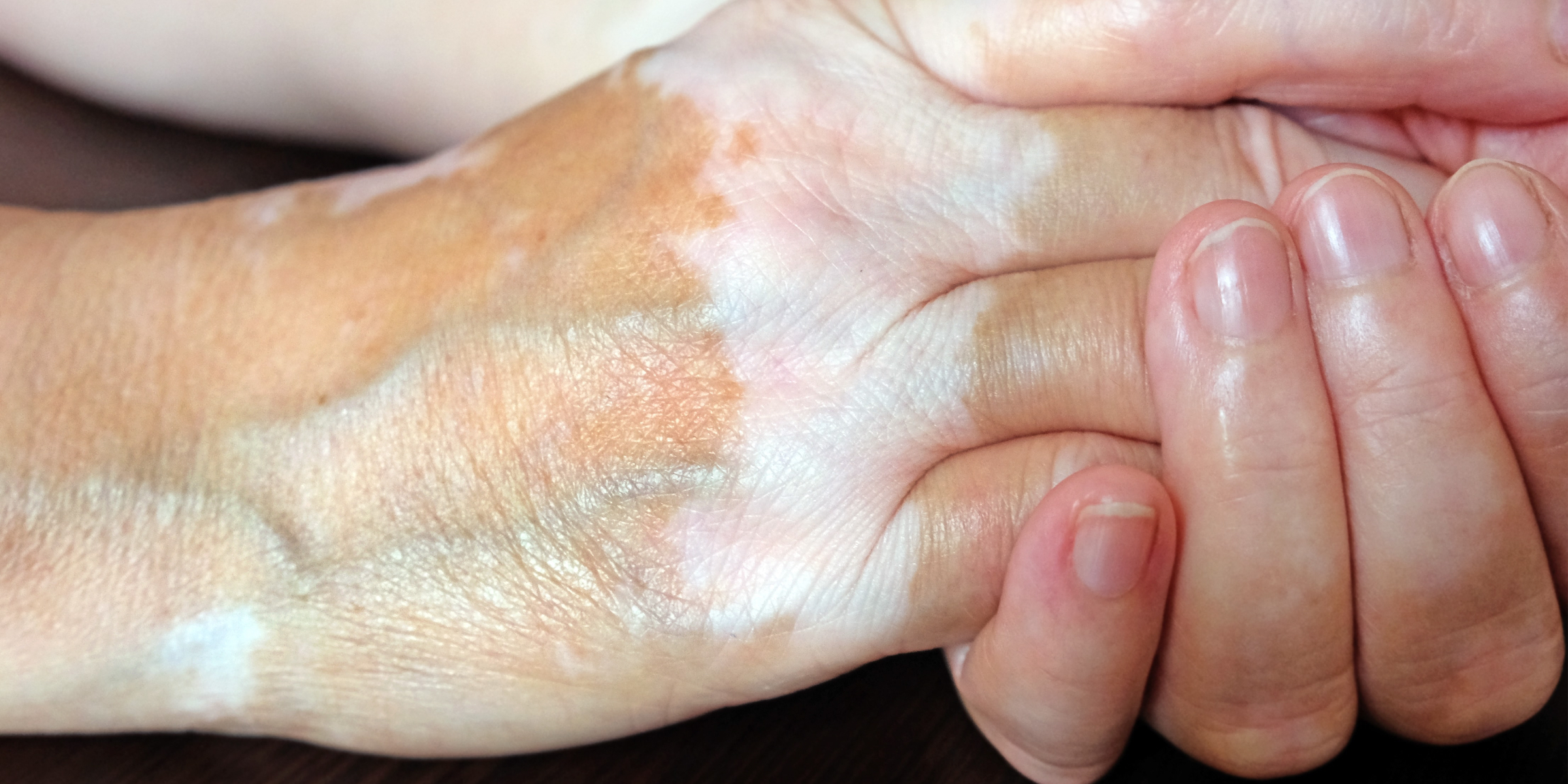 vitiligo on hands
