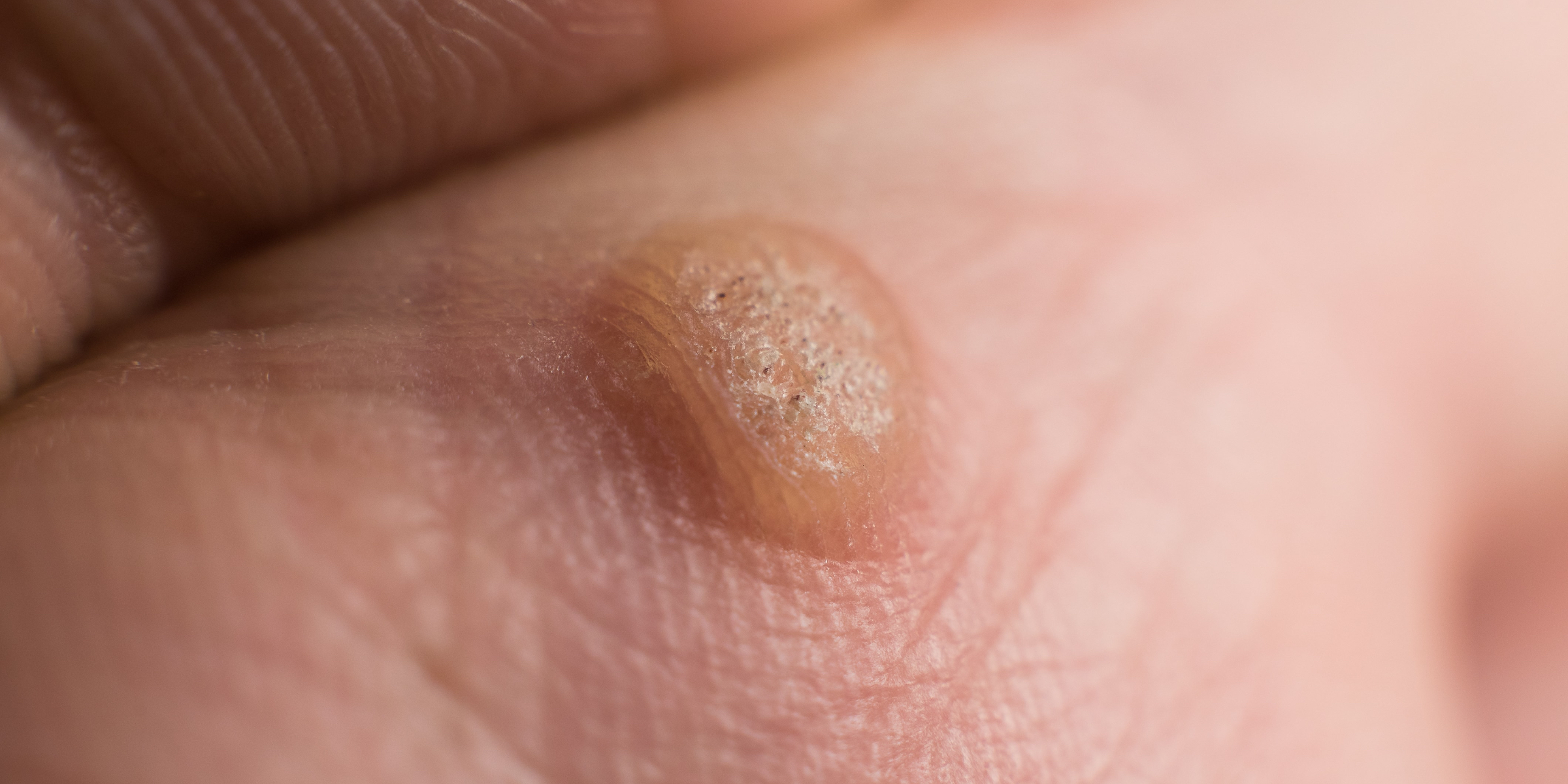 large wart on finger
