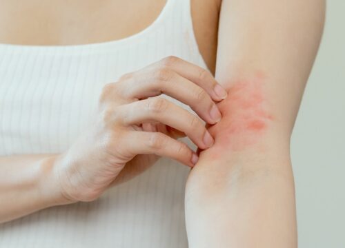 Understanding Eczema: Tips for Managing Flare-Ups During Fall & Winter