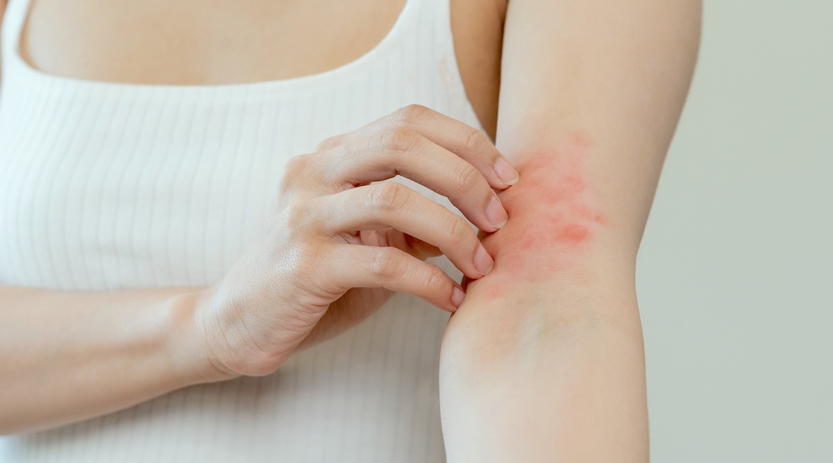 Understanding Eczema: Tips for Managing Flare-Ups During Fall & Winter