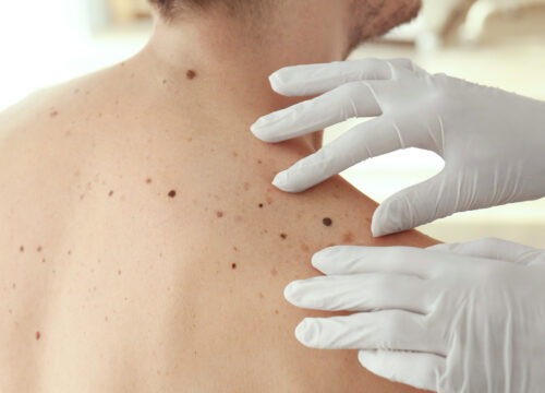 Start Summer with Confidence, Schedule Your Annual Skin Exam
