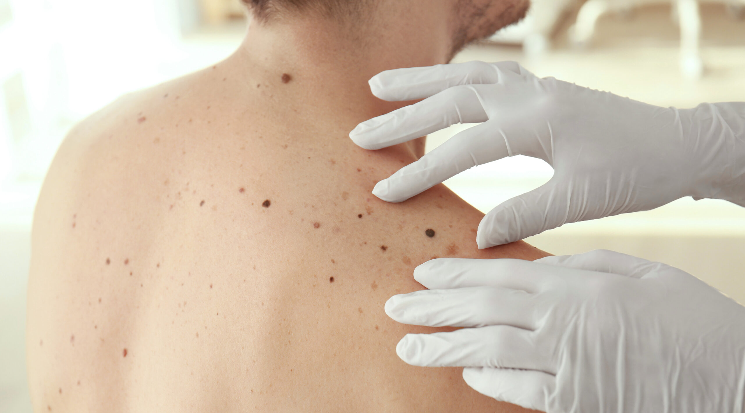 Start Summer with Confidence, Schedule Your Annual Skin Exam