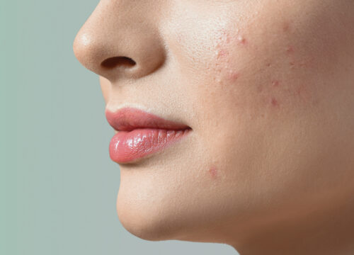 Acne Awareness Month: What Sets Coastal Dermatology + Aesthetics Apart