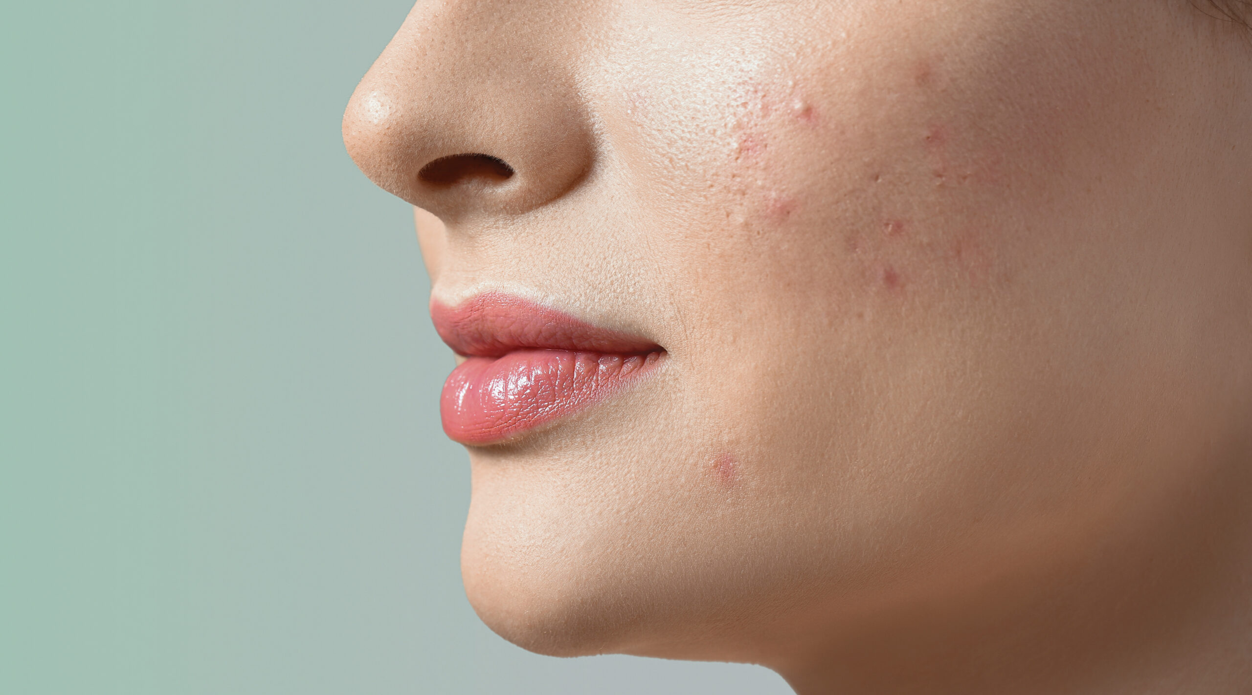 Acne Awareness Month: What Sets Coastal Dermatology + Aesthetics Apart