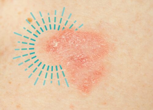 Eczema in the Fall