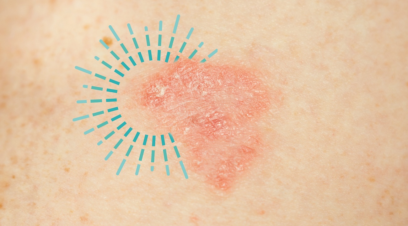 Eczema in the Fall
