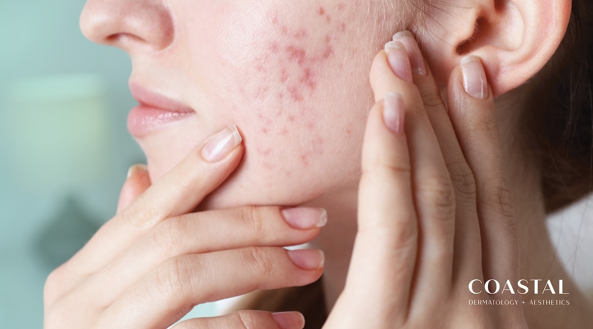 Rosacea Awareness Month – Understanding Facial Redness.