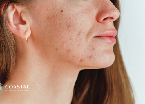 Adult Acne: Why It Happens in Your 30s, 40s, and Beyond (And What Actually Works)