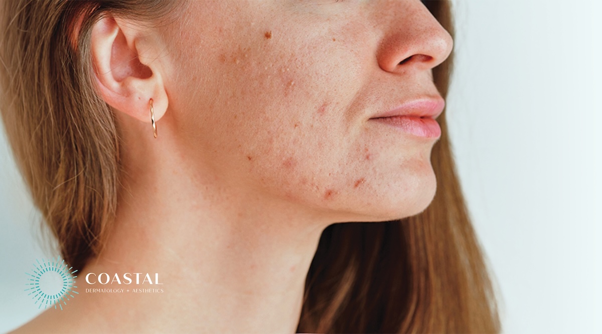 Adult Acne: Why It Happens in Your 30s, 40s, and Beyond (And What Actually Works)