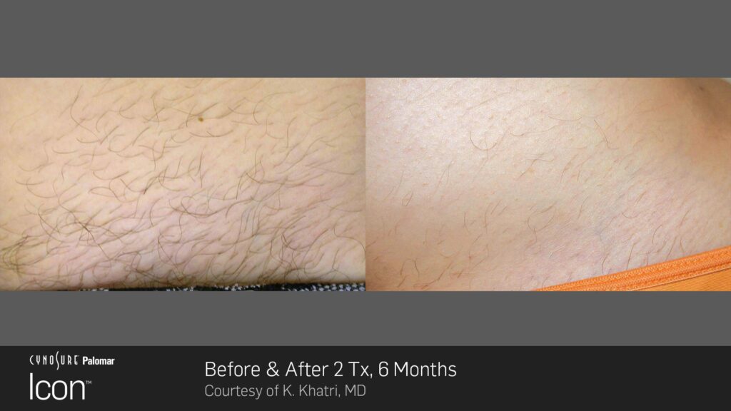 ICON™ Laser Hair Reduction Before & After Photos — before and after photograph