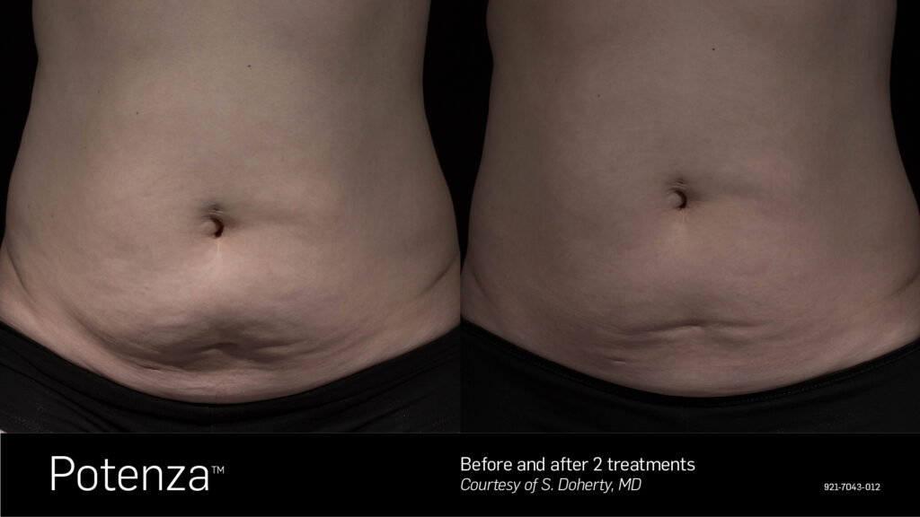 Potenza® RF Microneedling before and after result at Coastal Dermatology + Aesthetics, Patient 1