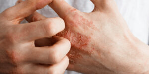 Atopic Dermatitis