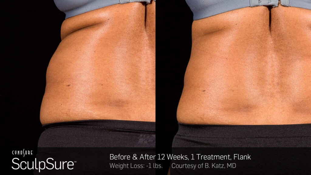SculpSure® Before & After Photos — before and after photograph
