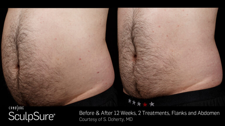 BA_SculpSure_Core_2tx_12wks.11.jpg