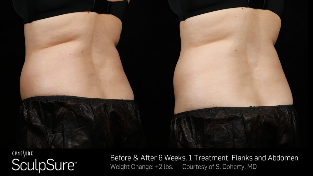 SculpSure® Before & After Photos — before and after photograph
