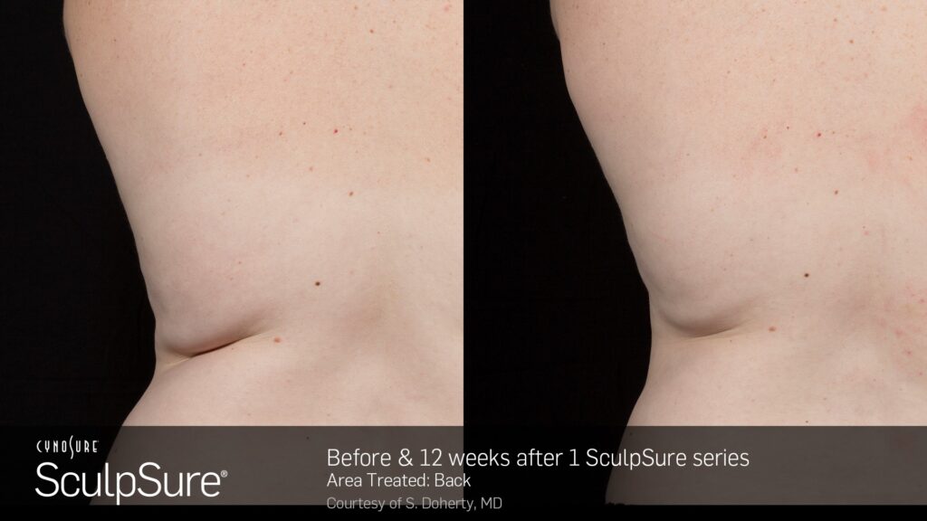SculpSure® Before & After Photos — before and after photograph