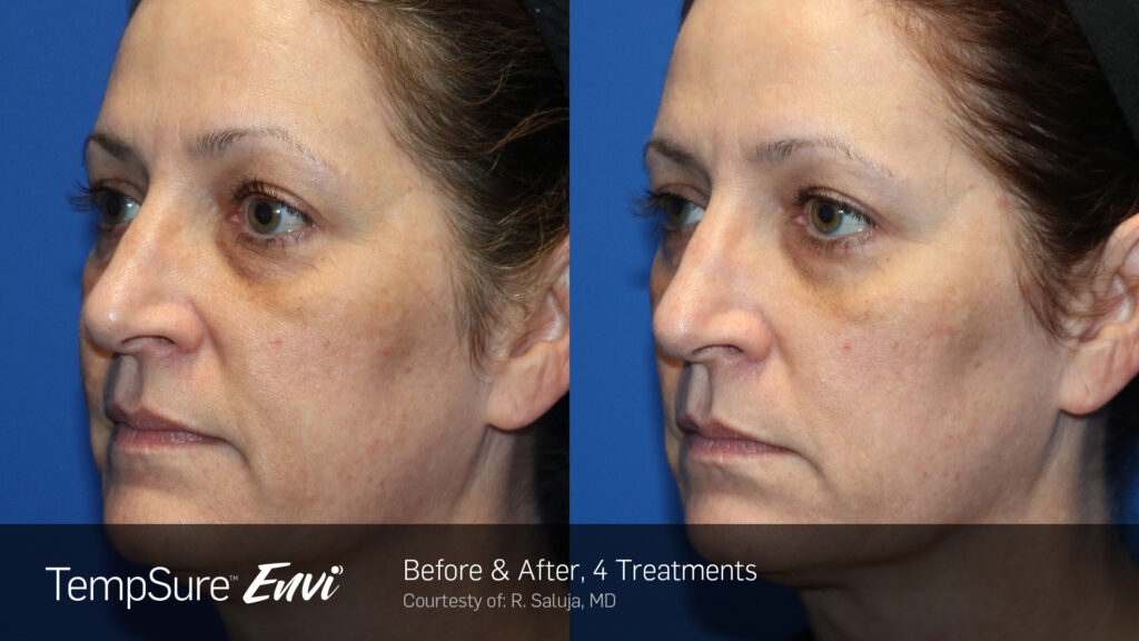 TempSure™ Envi Before & After Photos — before and after photograph