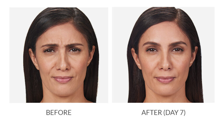 botox_1.jpg