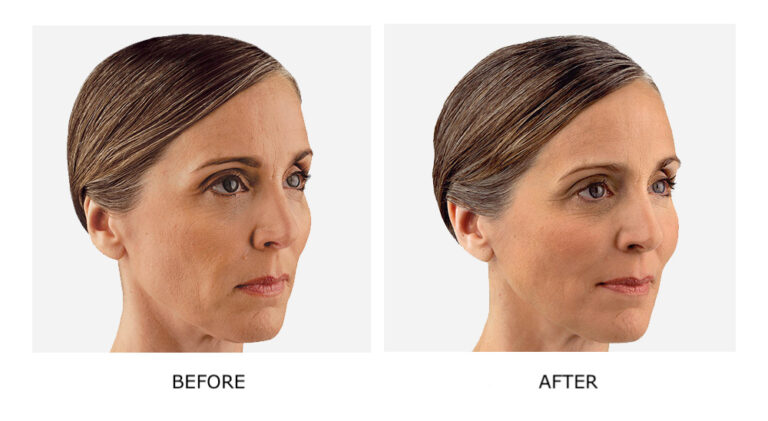 juvederm_1.jpg