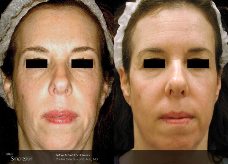 marketing_materials_BA-SmartSkin-BKatz-Post3tx-3Weeks.jpg