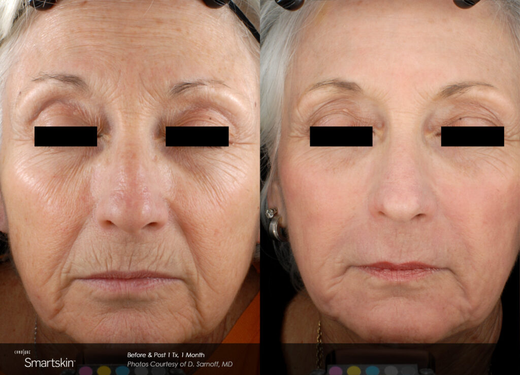 Smartskin®+ Before & After Photos — before and after photograph