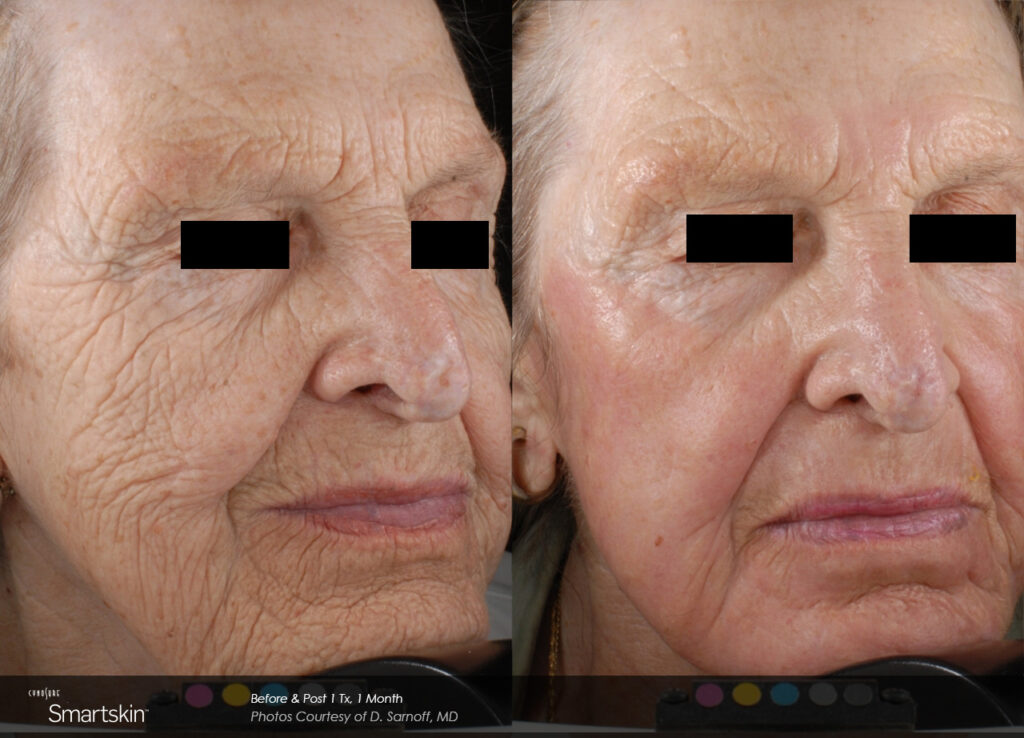 Smartskin®+ Before & After Photos — before and after photograph