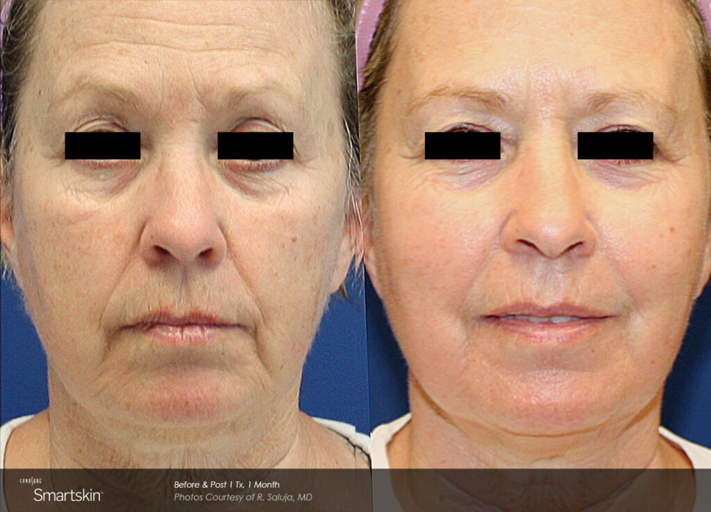 Smartskin®+ Before & After Photos — before and after photograph