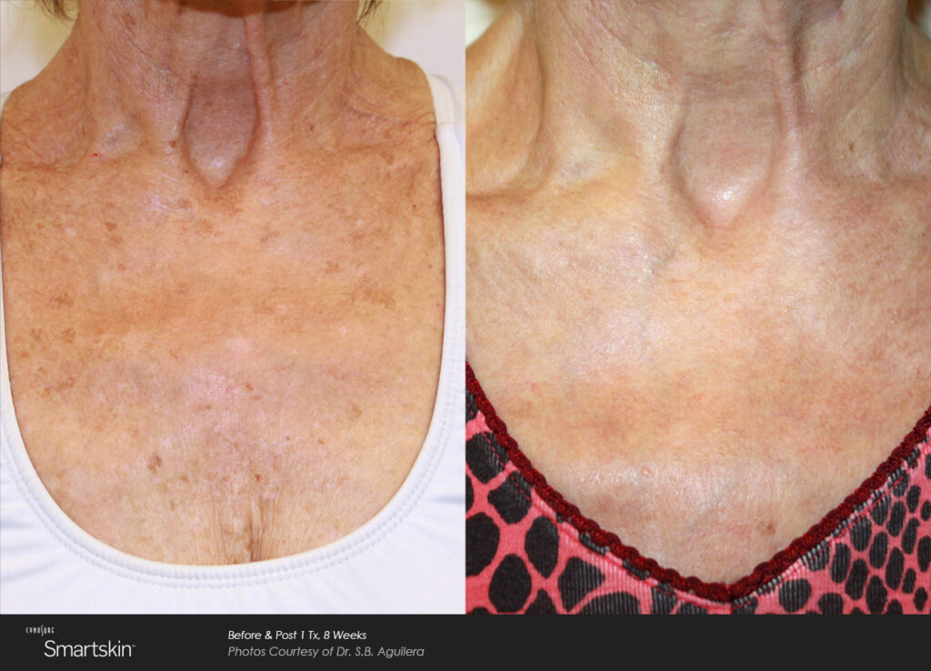 Smartskin®+ Before & After Photos — before and after photograph