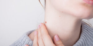 Moles