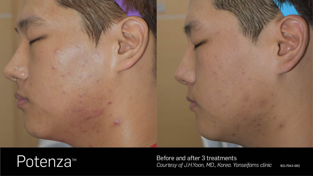 Potenza® RF Microneedling before and after result at Coastal Dermatology + Aesthetics, Patient 2