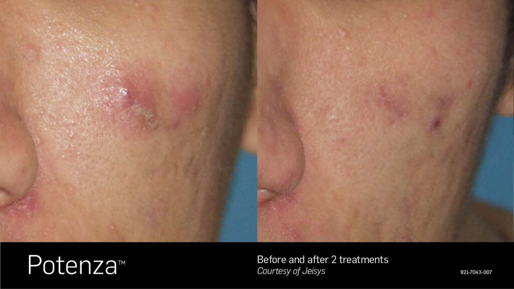 Potenza™ Before & After Photos — before and after photograph