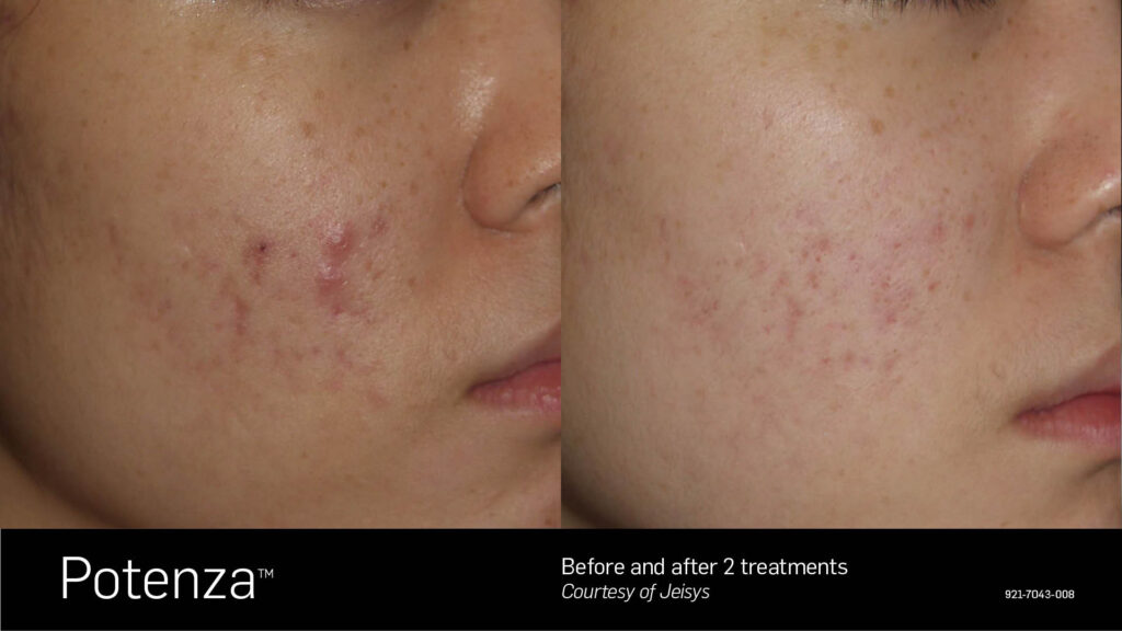Potenza™ Before & After Photos — before and after photograph