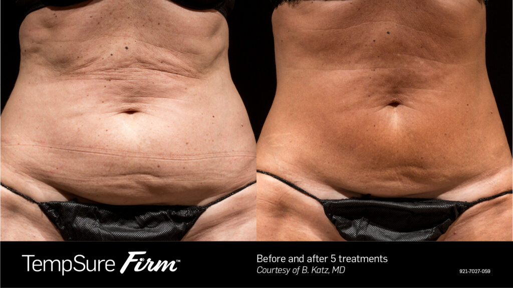 TempSure® Firm Body Tightening before and after result at Coastal Dermatology + Aesthetics, Patient 2