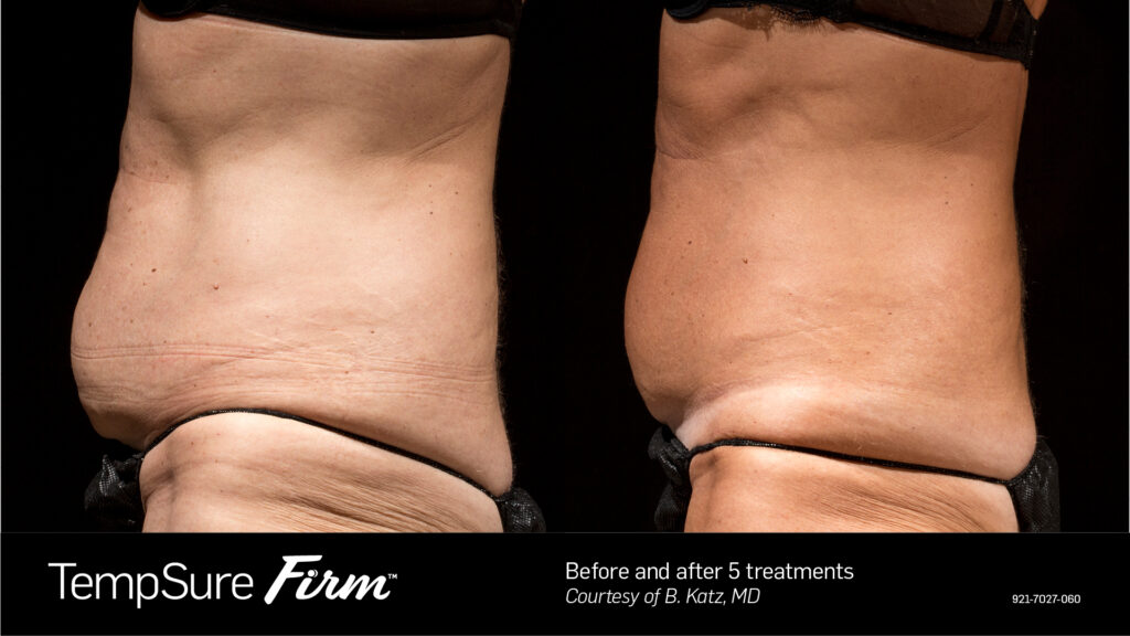 TempSure® Firm Body Tightening before and after result at Coastal Dermatology + Aesthetics, Patient 3