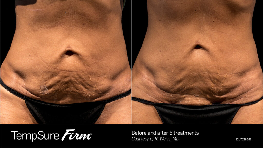TempSure™ Firm Before & After Photos — before and after photograph