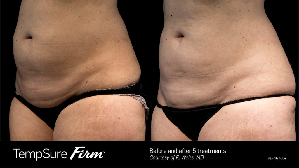 TempSure™ Firm Before & After Photos — before and after photograph