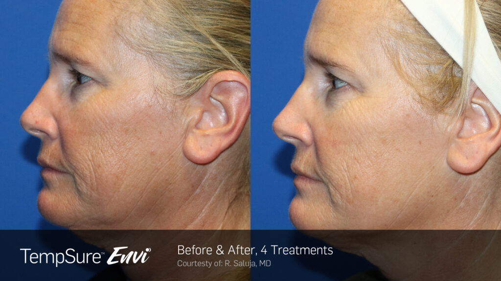 TempSure™ Envi Before & After Photos — before and after photograph