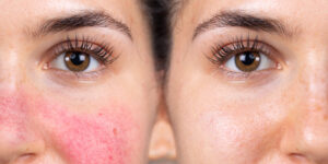 Rosacea