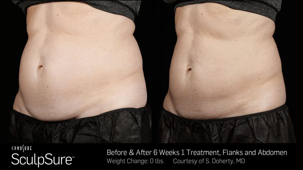 SculpSure® Body Contouring before and after result at Coastal Dermatology + Aesthetics, Patient 2