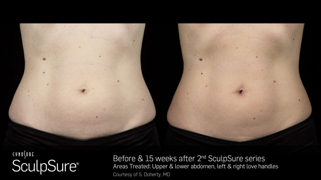 SculpSure® Body Contouring before and after result at Coastal Dermatology + Aesthetics, Patient 3
