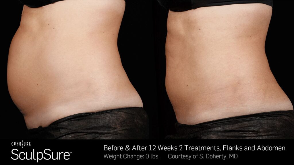 SculpSure® Before & After Photos — before and after photograph